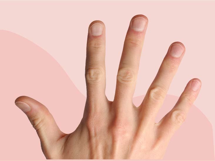 White spots on nails: Zinc deficiency and fungal infection among causes |  Express.co.uk