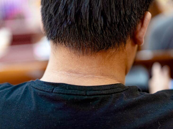 How to get rid of 'tech neck' — creases in your neck that aren't caused by  age