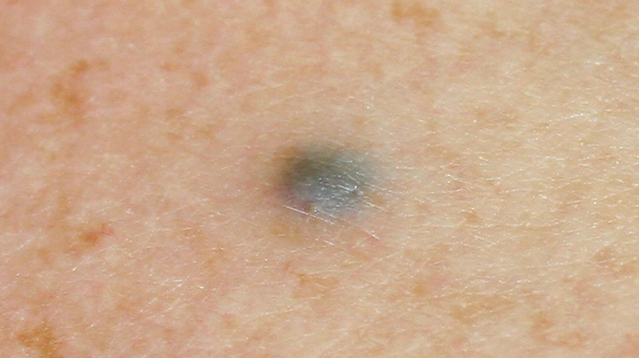 Blue Nevus - American Osteopathic College of Dermatology (AOCD)