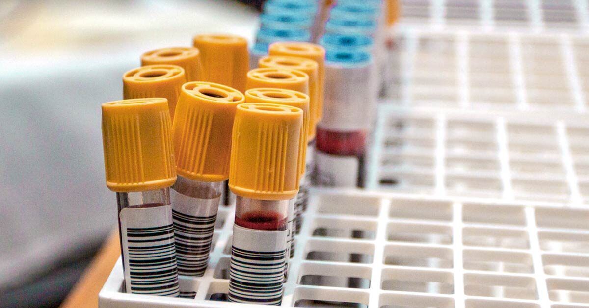 Aspartate Aminotransferase (AST) Test (SGOT) Purpose