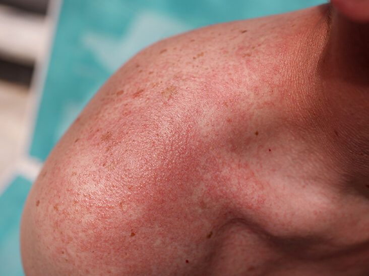 Heat rash, sun rash -- what's the difference?