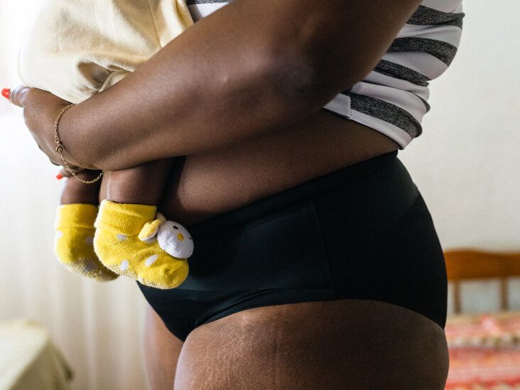 How to Prevent Stretch Marks: 7 Tips
