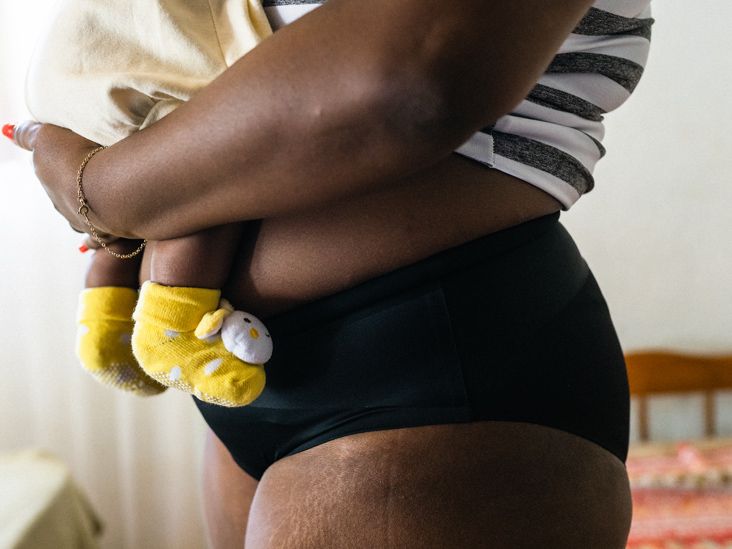 stretch marks after pregnancy on black women