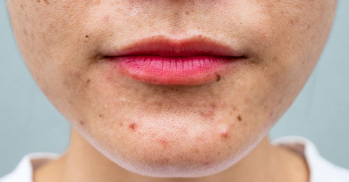 When Does Acne Stop? Understanding The Causes & Treatments
