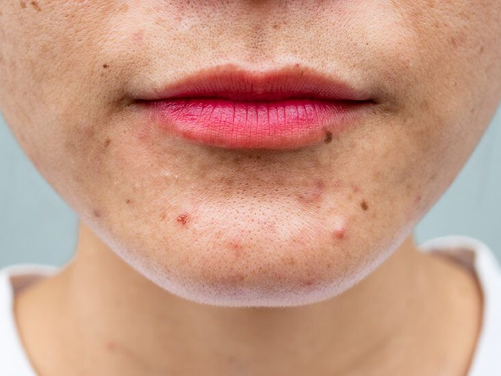 What Causes Pimple on the Face  