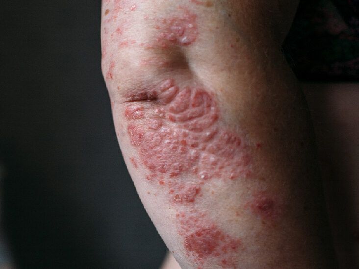 How Does the PASI Score Test Psoriasis?