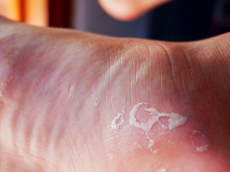 Why does skin peeling occur on the feet?