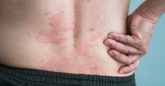 Idiopathic Urticaria Chronic Urticaria hives PEF Norge Idiopathic Urticaria Chronic Urticaria hives PEF Norge