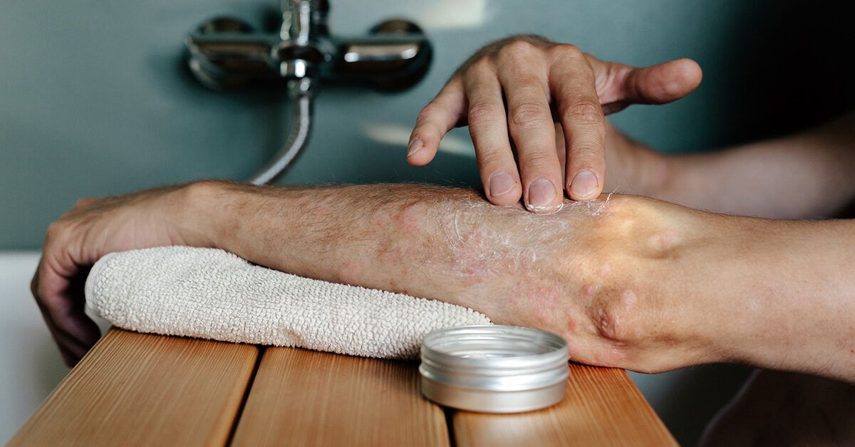 Shingles vs Eczema Skin Rash and Symptom Differences