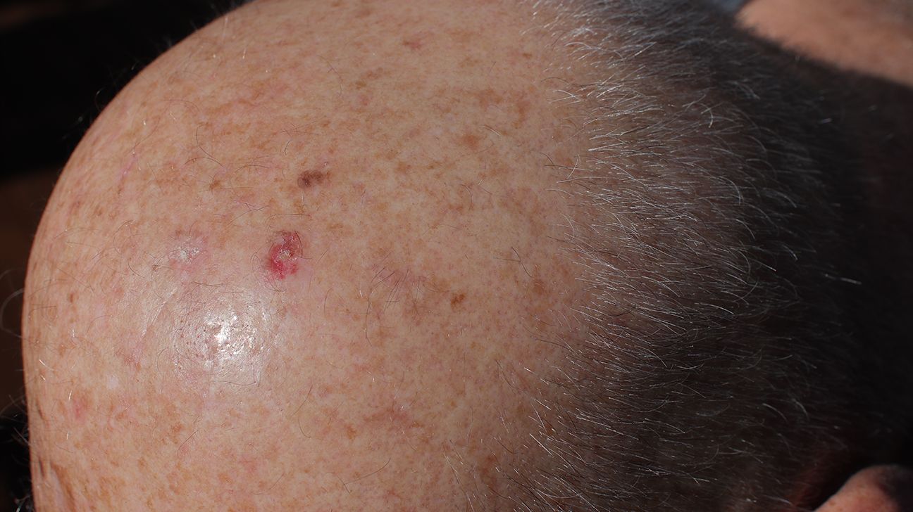 Seborrheic Dermatitis Raleigh Nc