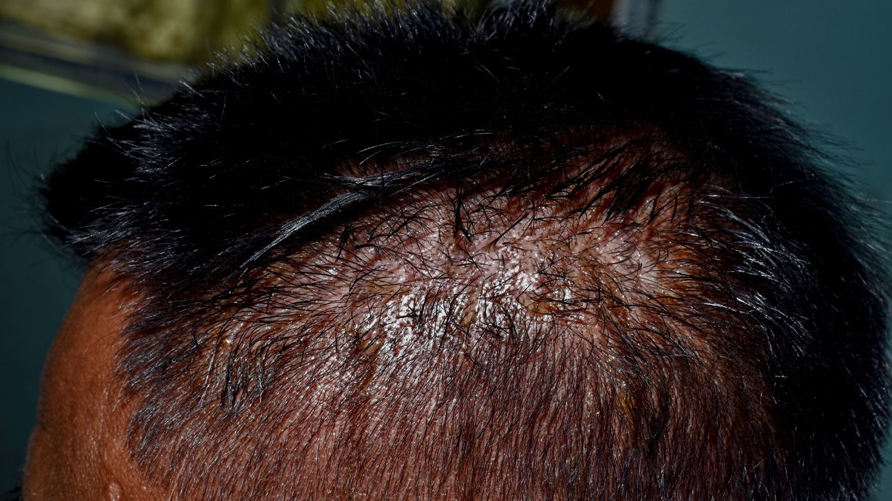 seborrheic dermatitis