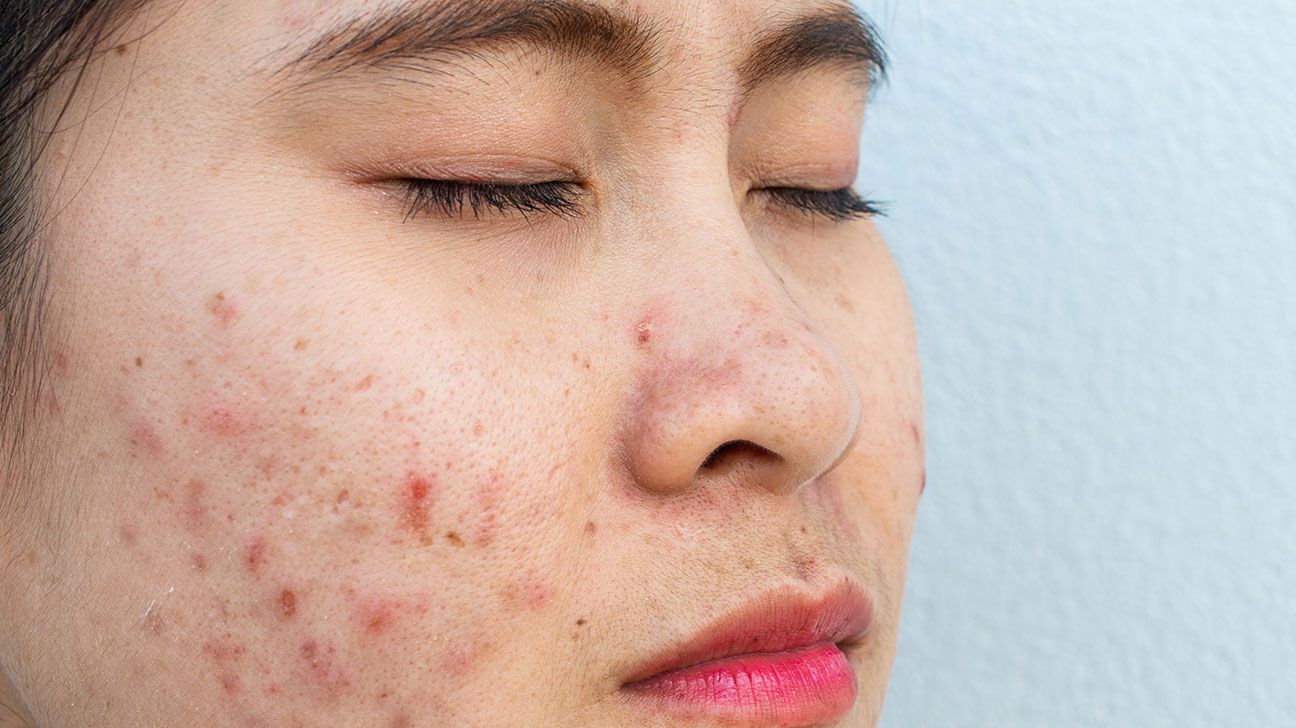 The Negative Ways Makeup Can Affect Your Skin And How You Can