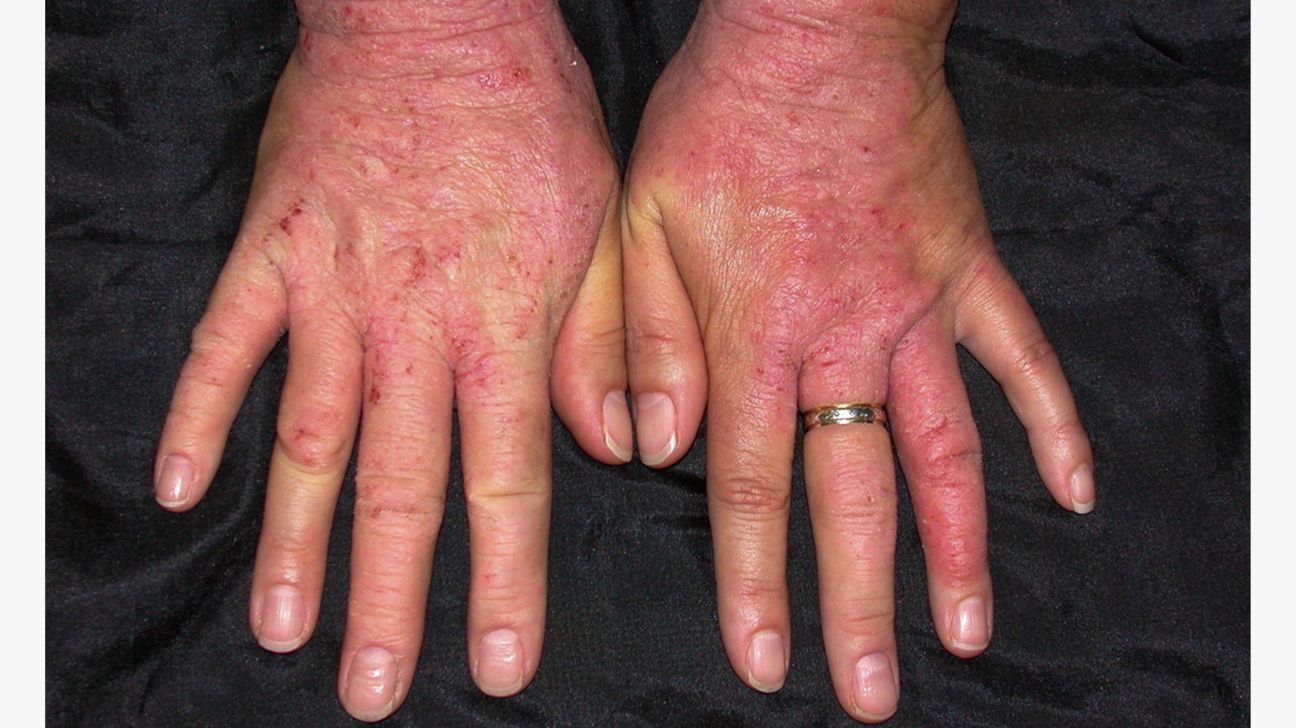 Sweaty Palms/Underarms | Hyperhidrosis Treatment Singapore