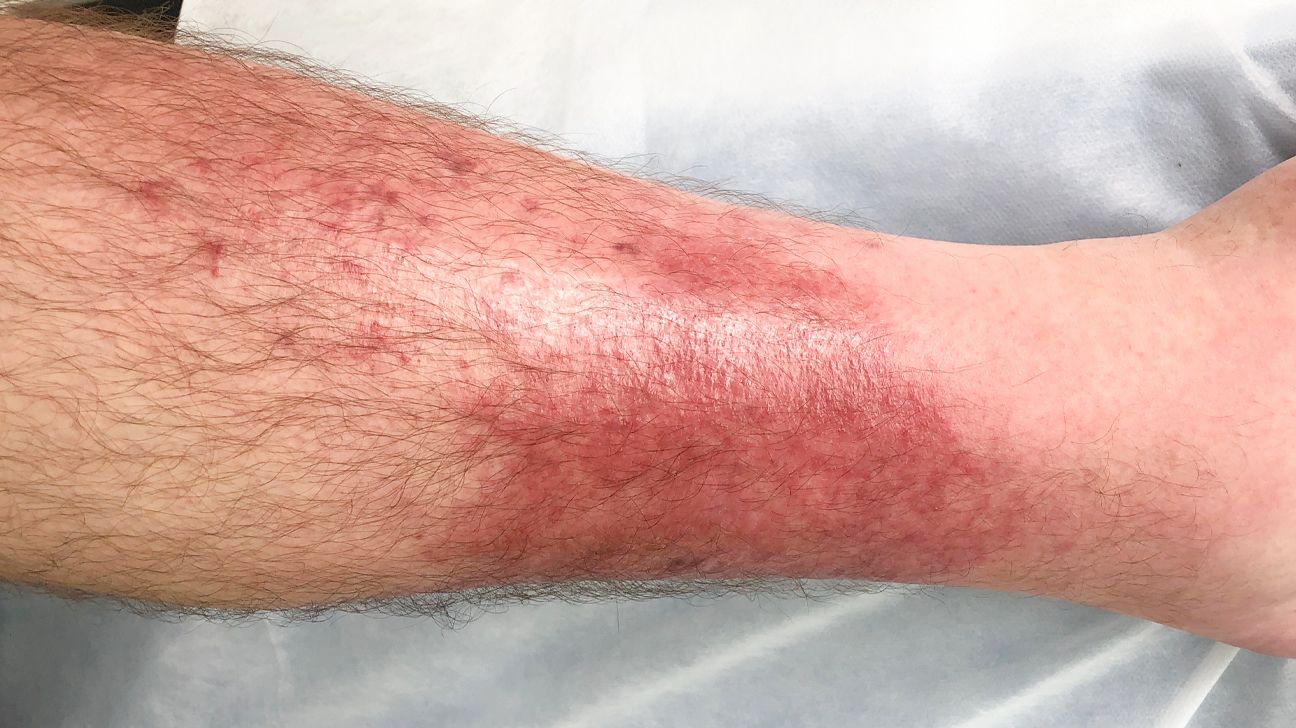 Seborrheic Dermatitis Raleigh Nc