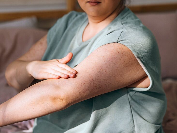 Is There a Link Between Psoriasis and Obesity?