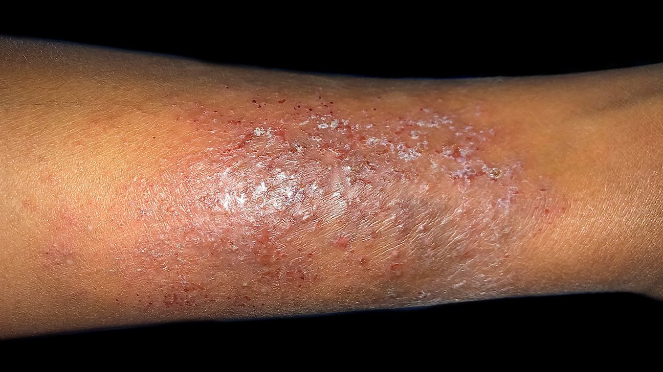 Seborrheic Dermatitis Raleigh Nc