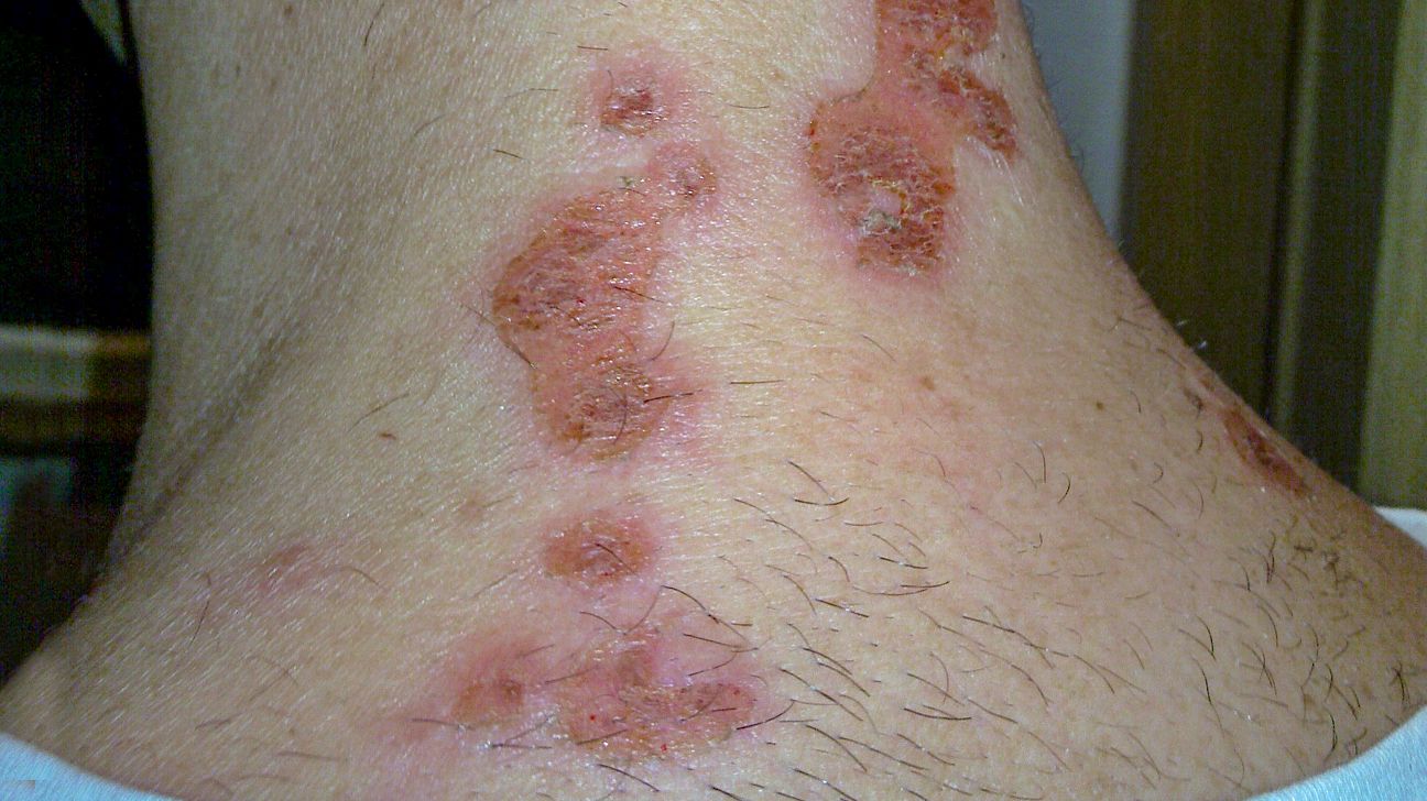 Woman Body Skin Rash With Red Allergy Eruption Stock Photo - Alamy