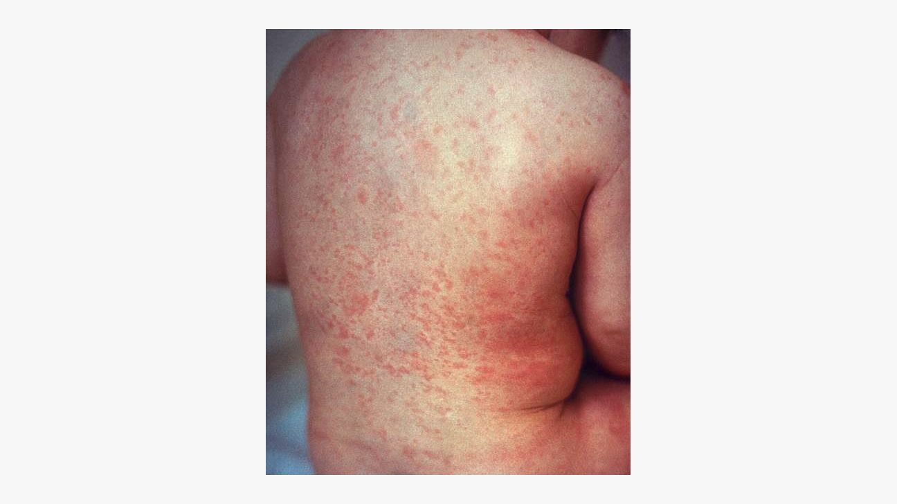 Seborrheic Dermatitis Raleigh Nc