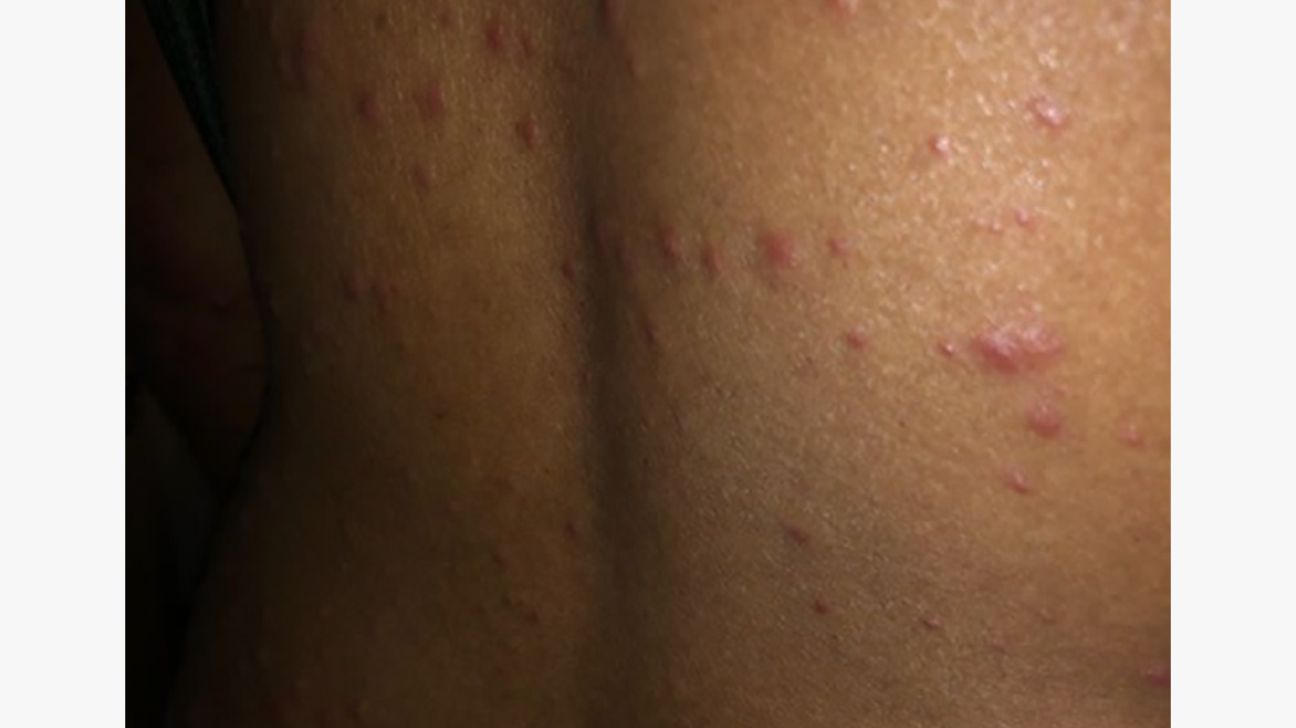 Seborrheic Dermatitis Raleigh Nc