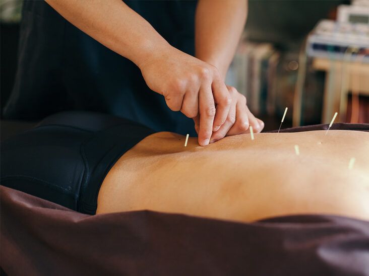 How Acupuncture May Relieve Symptoms of Multiple Sclerosis