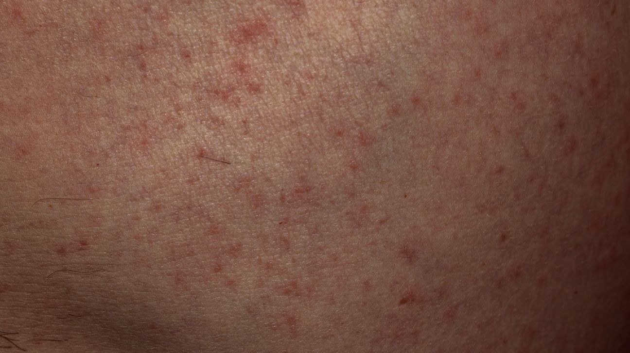 Scarlet Fever: Signs, Symptoms, and Complicatons