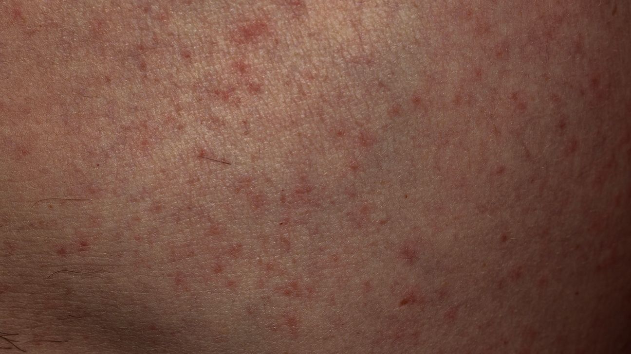 streptococcal pharyngitis rash