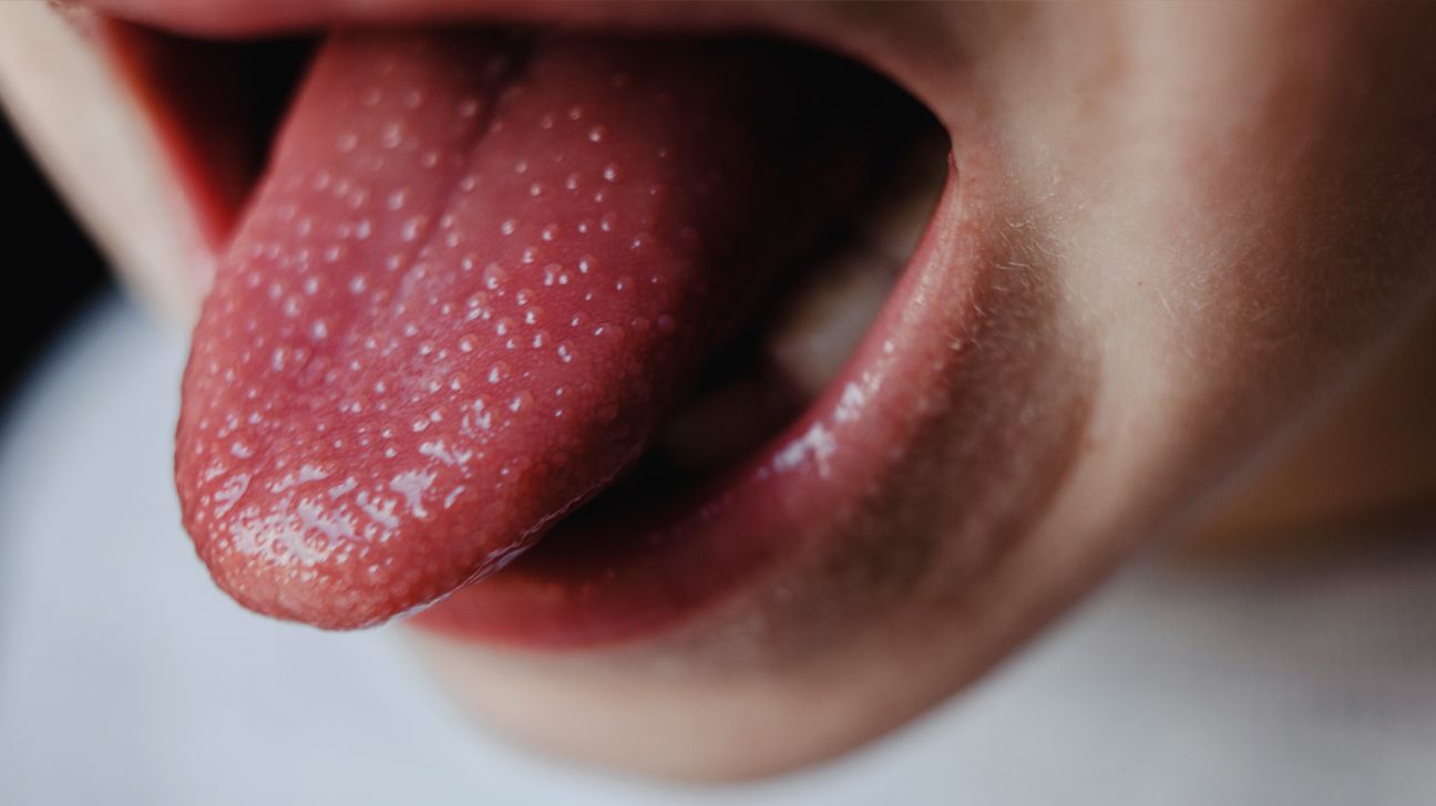 Scarlet Fever: All You Need to Know