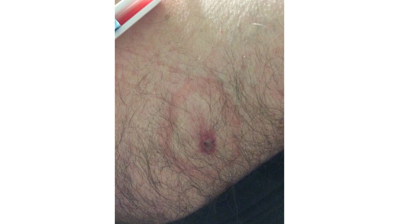 Spider Bite Pictures: What They Look Like and Tips to Identify