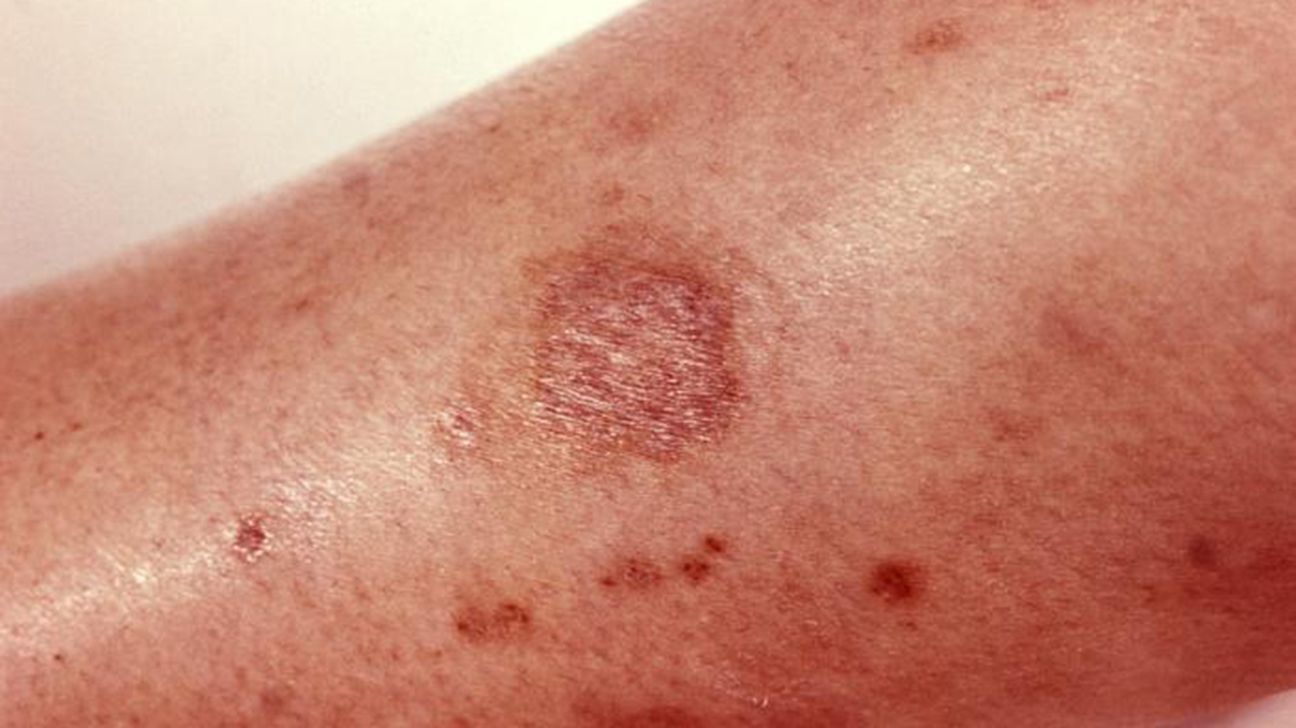 Spider bites: Identification and treatment