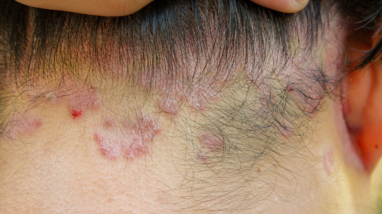 Fungal Infection in the Groin, Psoriasis, Dermatitis, Eczema. Stock Photo -  Image of dermatophytic, dermatitis: 140548058