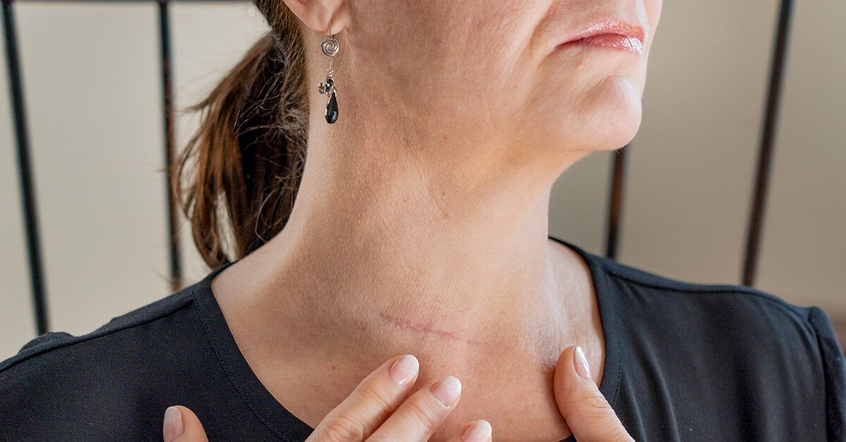 thyroid cancer scar