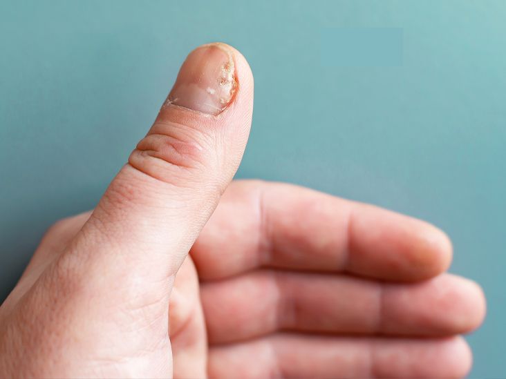Nail Psoriasis Severity Index What It Is and How Doctors Use It
