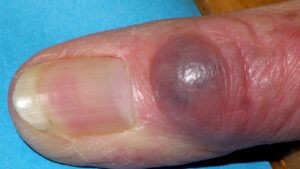 a myxoid cyst located near the fingernail