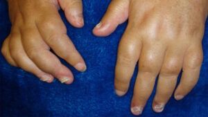 the swollen hands and fingers of a person with dactylitis