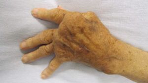 the left hand of a person with rheumatoid arthritis