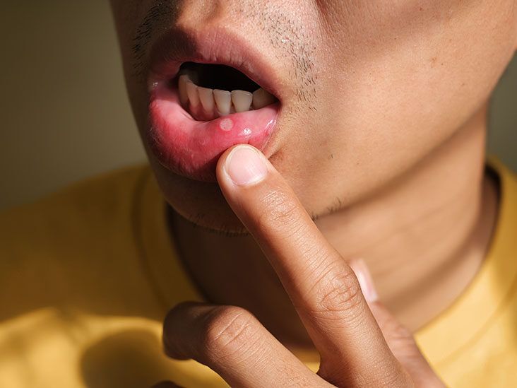 what causes blisters in throat