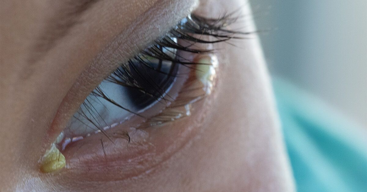 What Causes Crusty Dry Eye Discharge?