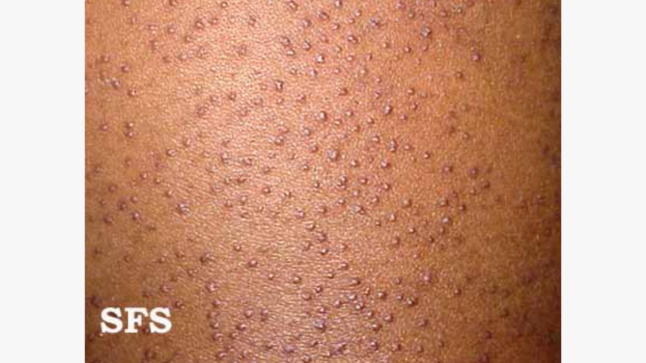 keratosis pilaris on black skin