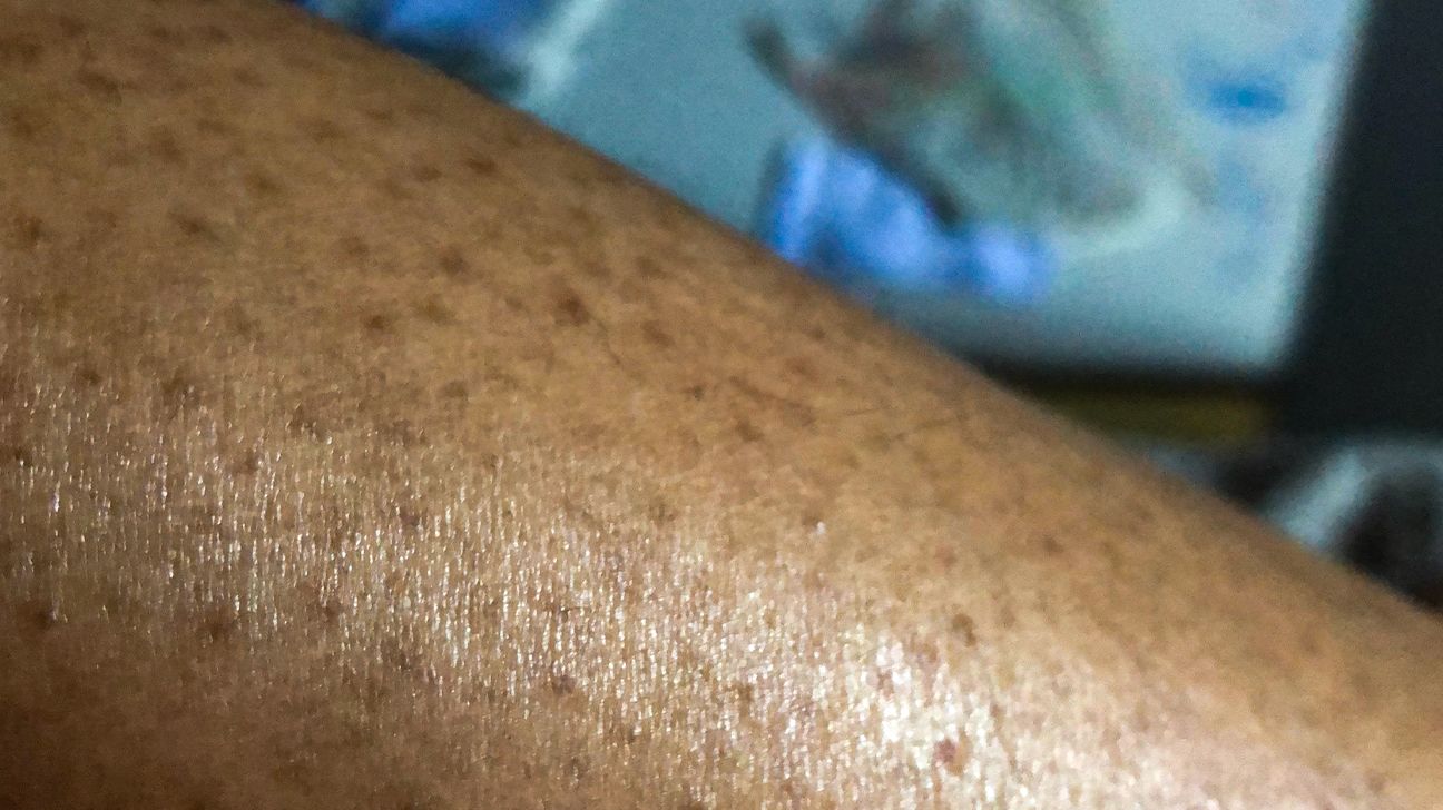 black bumps on skin