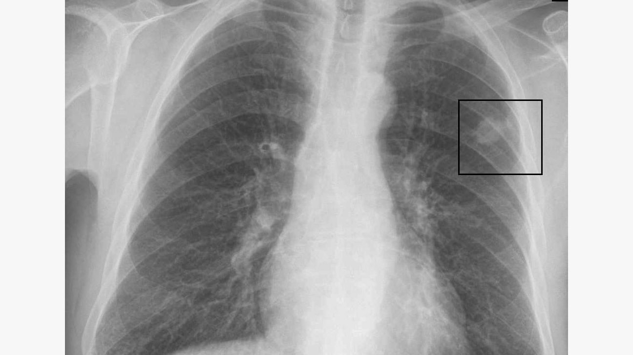 lungeknude på et røntgenbillede, lungeknudestørrelsesdiagram