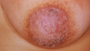 Paget's Disease of the Breast: What Is It, Symptoms, Treatment
