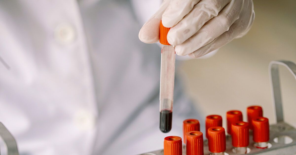 How to Diagnose Lupus Tests, FAQs, and More