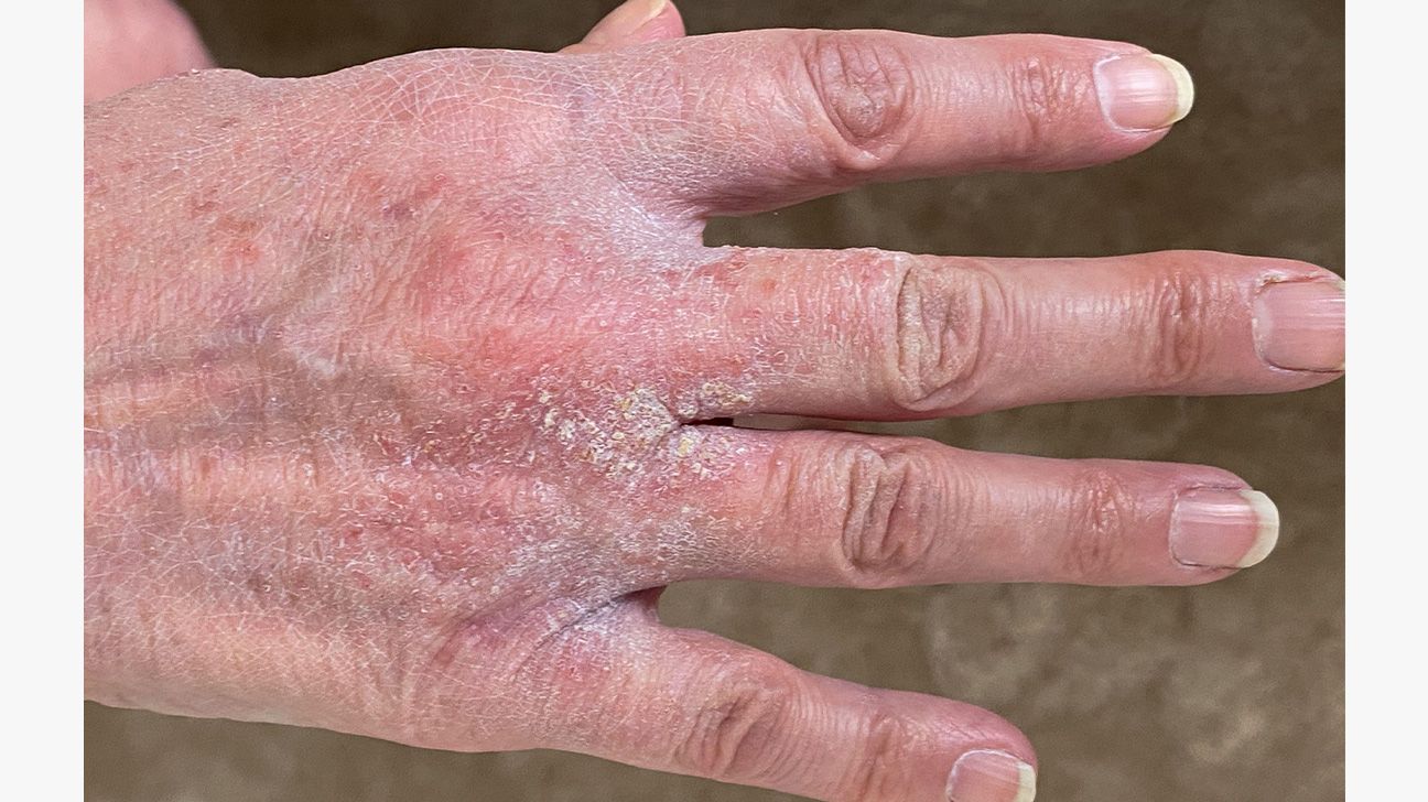 Scabies (Skin Condition)  What Is It, Classic vs. Crusted Types, Signs &  Symptoms, Treatment 