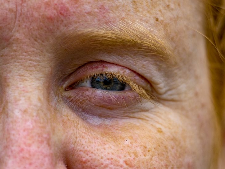 Is Blepharitis Contagious What You Need To Know 