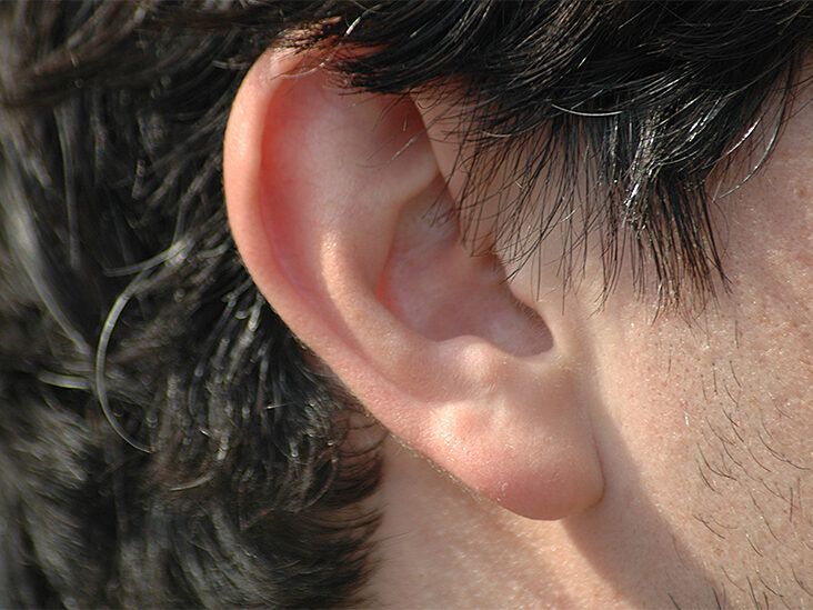 Ear Irrigation: Purpose, Procedures and Risks
