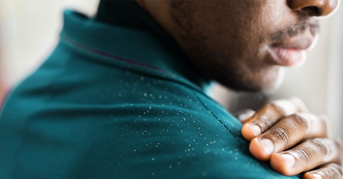 Dandruff Vs. Eczema Causes, Symptoms, and Treatment