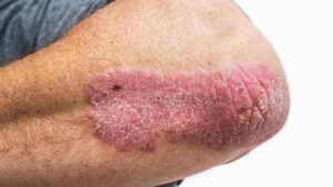 Elbow psoriasis plaque.