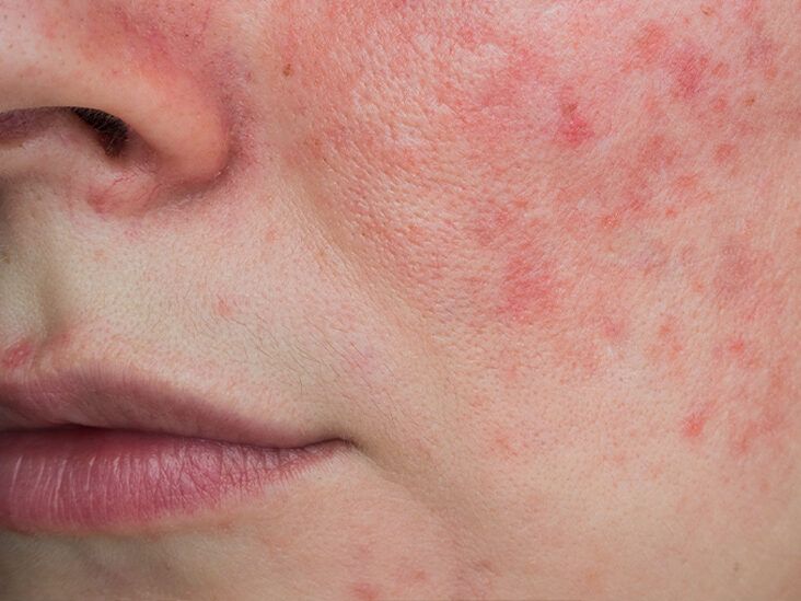 Skin Discoloration With Lupus: Red Spots, Orange Spots, and More