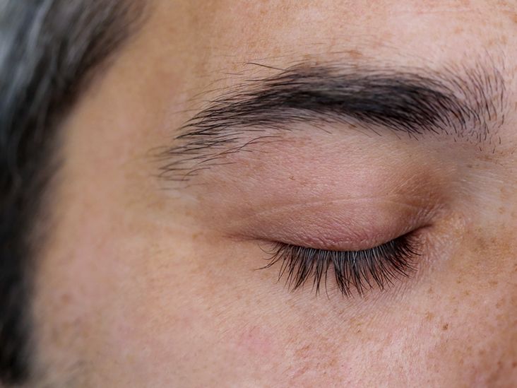 Squamous Blepharitis Inflamed Eyelids and More