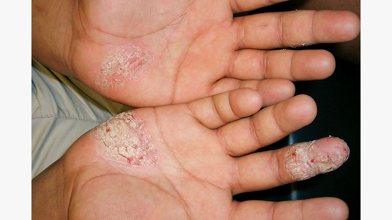 mild psoriasis hands